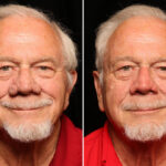 Reconstructive / Other Before and After Photos in Cincinnati, OH, Patient 12089