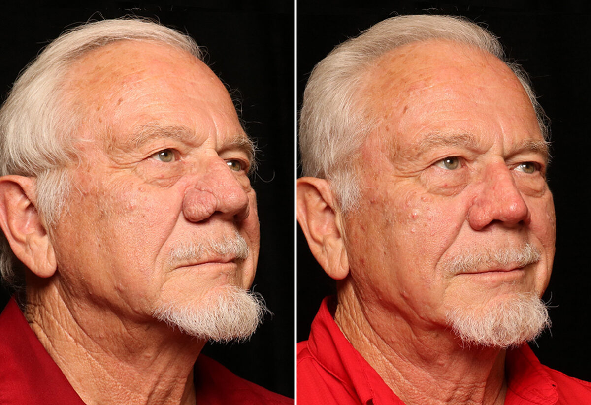 Reconstructive / Other Before and After Photos in Cincinnati, OH, Patient 12089