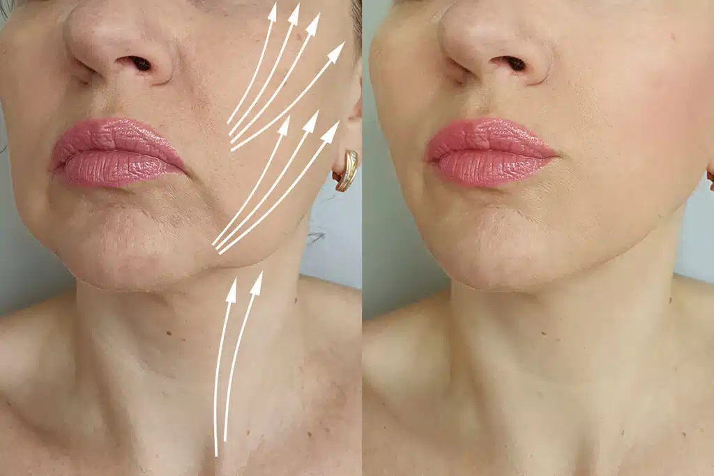 Before and after pictures of a facelift patient.