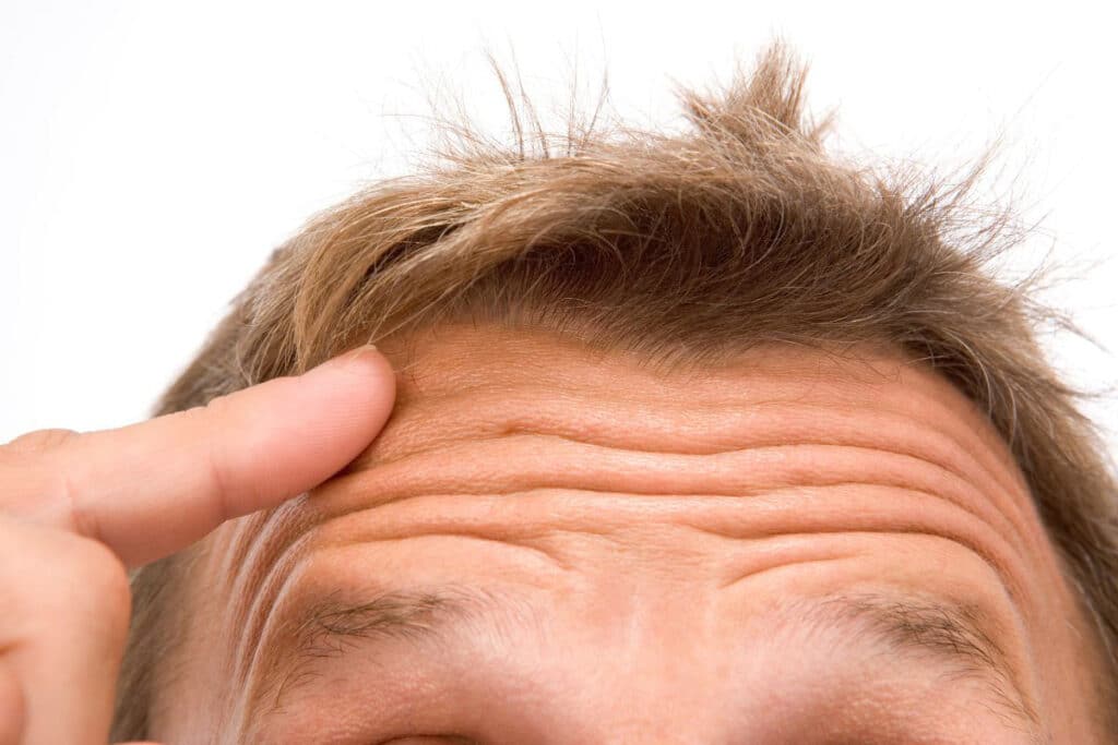 Facial expressions such as frowning can cause wrinkles and deep lines over time, which can be addressed with a brow lift procedure.