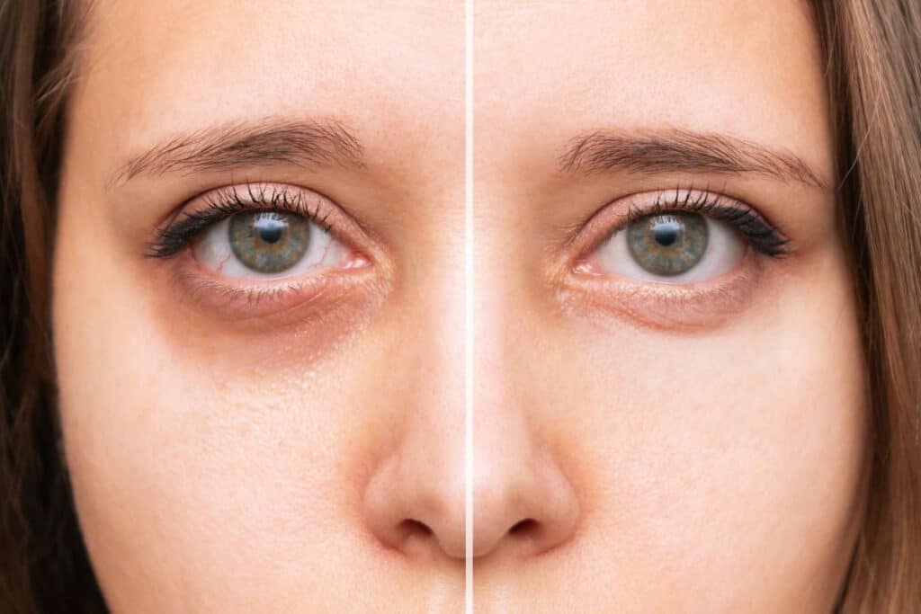 Dr. Donath offers a variety of treatment options to rejuvenate tired eyes, such as eyelid surgery, fillers, Botox, and laser resurfacing.