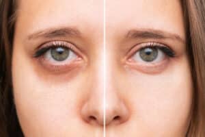 Dr. Donath offers a variety of treatment options to rejuvenate tired eyes, such as eyelid surgery, fillers, Botox, and laser resurfacing.