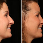 Rhinoplasty (Nose Reshaping) Before and After Photos in Cincinnati, OH, Patient 12082