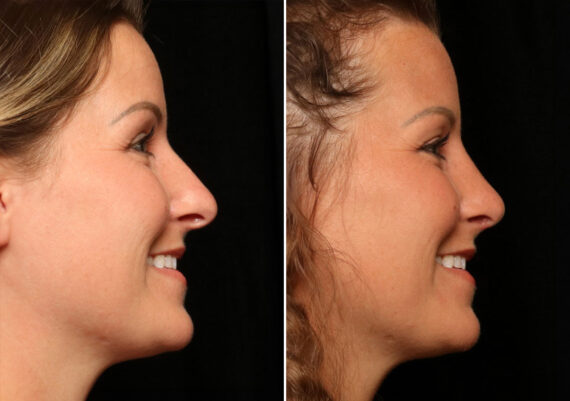 Rhinoplasty (Nose Reshaping) Before and After Photos in Cincinnati, OH, Patient 12082