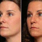 Rhinoplasty (Nose Reshaping) Before and After Photos in Cincinnati, OH, Patient 12082