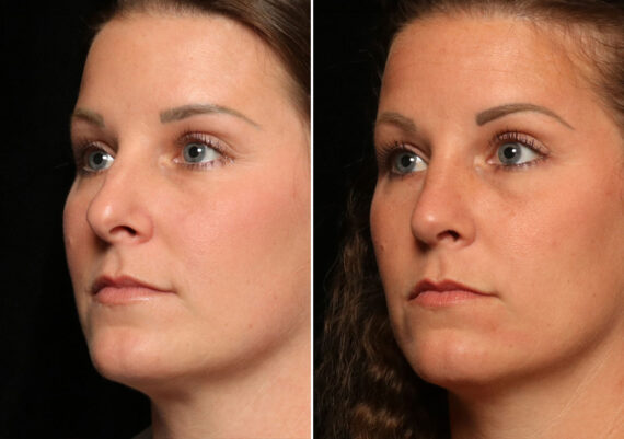 Rhinoplasty (Nose Reshaping) Before and After Photos in Cincinnati, OH, Patient 12082