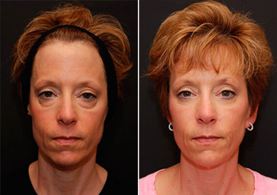 Blepharoplasty Before and After Photos in Cincinnati, OH, Patient 5449