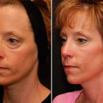 Blepharoplasty Before and After Photos in Cincinnati, OH, Patient 5449
