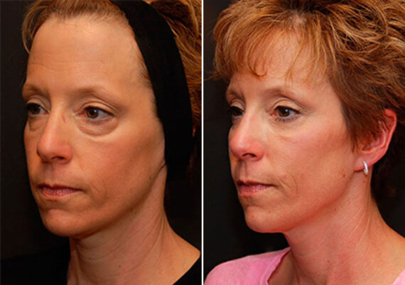 Blepharoplasty Before and After Photos in Cincinnati, OH, Patient 5449