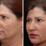 Facial Liposuction Before and After Photos in Cincinnati, OH, Patient 5650