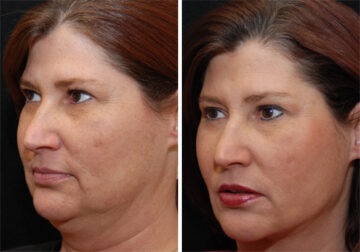 Facial Liposuction Before and After Photos in Cincinnati, OH, Patient 5650