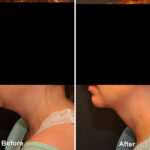 Facial Liposuction Before and After Photos in Cincinnati, OH, Patient 5658