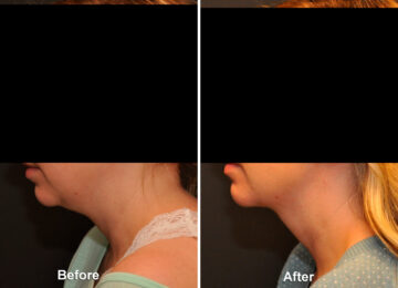 Facial Liposuction Before and After Photos in Cincinnati, OH, Patient 5658