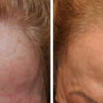 Hair Transplantation Before and After Photos in Cincinnati, OH, Patient 5753