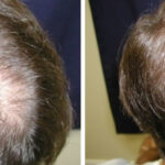 Hair Transplantation Before and After Photos in Cincinnati, OH, Patient 5768