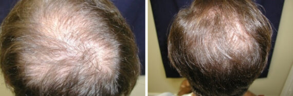 Hair Transplantation Before and After Photos in Cincinnati, OH, Patient 5768