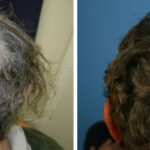 Hair Transplantation Before and After Photos in Cincinnati, OH, Patient 5777