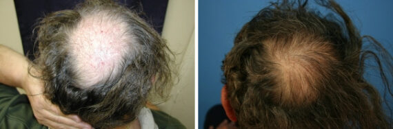 Hair Transplantation Before and After Photos in Cincinnati, OH, Patient 5777