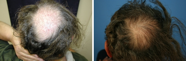 Hair Transplantation Before and After Photos in Cincinnati, OH, Patient 5777