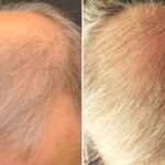 Hair Transplantation Before and After Photos in Cincinnati, OH, Patient 5783
