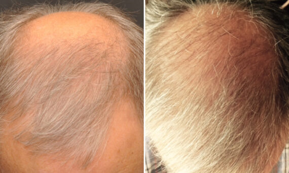 Hair Transplantation Before and After Photos in Cincinnati, OH, Patient 5783
