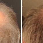 Hair Transplantation Before and After Photos in Cincinnati, OH, Patient 5783