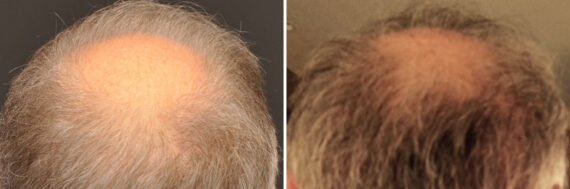 Hair Transplantation Before and After Photos in Cincinnati, OH, Patient 5783