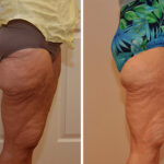 Liposonix Before and After Photos in Cincinnati, OH, Patient 5844