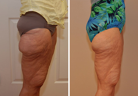 Liposonix Before and After Photos in Cincinnati, OH, Patient 5844