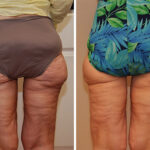 Liposonix Before and After Photos in Cincinnati, OH, Patient 5844