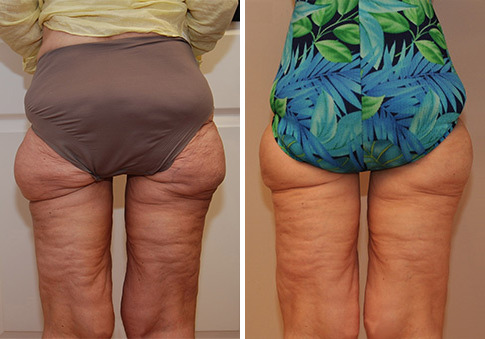 Liposonix Before and After Photos in Cincinnati, OH