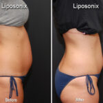 Liposonix Before and After Photos in Cincinnati, OH, Patient 5849