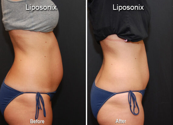 Liposonix Before and After Photos in Cincinnati, OH, Patient 5849