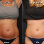 Liposonix Before and After Photos in Cincinnati, OH, Patient 5849