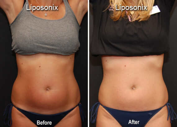 Liposonix Before and After Photos in Cincinnati, OH