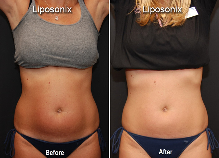 Liposonix Before and After Photos in Cincinnati, OH, Patient 5849