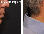 Minilift / Facelift Before and After Photos in Cincinnati, OH, Patient 6036