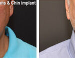 Minilift / Facelift Before and After Photos in Cincinnati, OH, Patient 6036