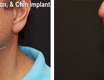 Minilift / Facelift Before and After Photos in Cincinnati, OH, Patient 6036