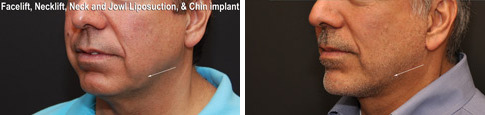 Minilift / Facelift Before and After Photos in Cincinnati, OH, Patient 6036