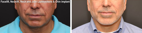 Minilift / Facelift Before and After Photos in Cincinnati, OH, Patient 6036