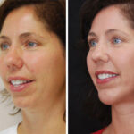 Chin Augmentation Before and After Photos in Cincinnati, OH, Patient 6056