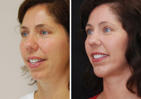 Chin Augmentation Before and After Photos in Cincinnati, OH, Patient 6056