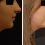 Chin Augmentation Before and After Photos in Cincinnati, OH, Patient 6059