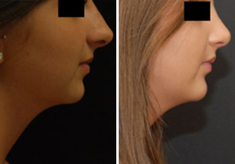 Chin Augmentation Before and After Photos in Cincinnati, OH, Patient 6059