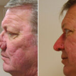 Reconstructive / Other Before and After Photos in Cincinnati, OH, Patient 6105