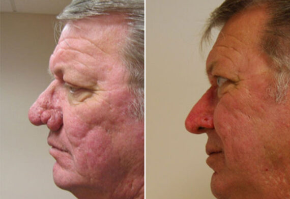 Reconstructive / Other Before and After Photos in Cincinnati, OH, Patient 6105