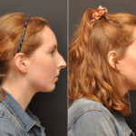 Rhinoplasty (Nose Reshaping) Before and After Photos in Cincinnati, OH, Patient 7951