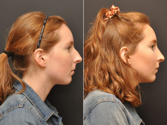 Rhinoplasty (Nose Reshaping) Before and After Photos in Cincinnati, OH, Patient 7951