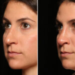 Rhinoplasty (Nose Reshaping) Before and After Photos in Cincinnati, OH, Patient 12701